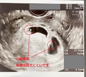 6週 36週 エコー写真付き 二卵性双子のお腹と体験談 まさらママのサバイバル生活