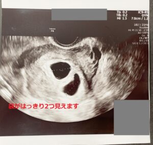 6週 36週 エコー写真付き 二卵性双子のお腹と体験談 まさらママのサバイバル生活